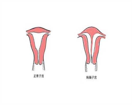 宫腔粘连致不孕